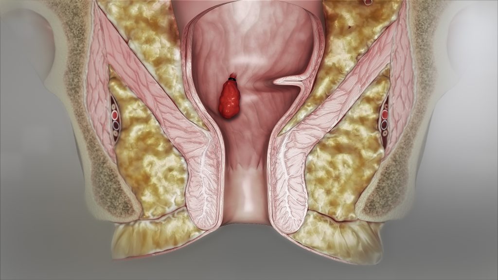 What Does a Hemorrhoid Look Like