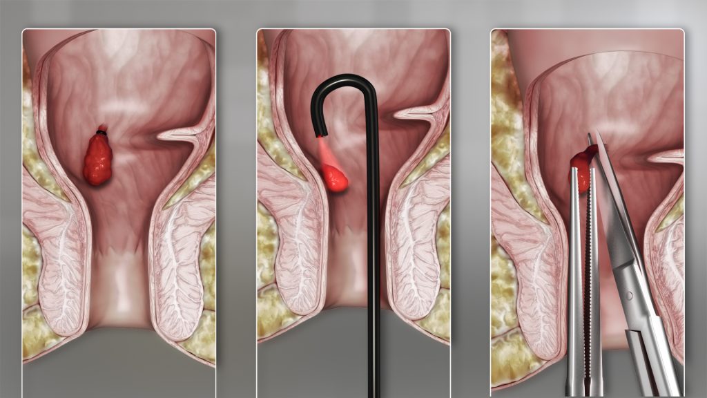 What Does a Hemorrhoid Look Like
