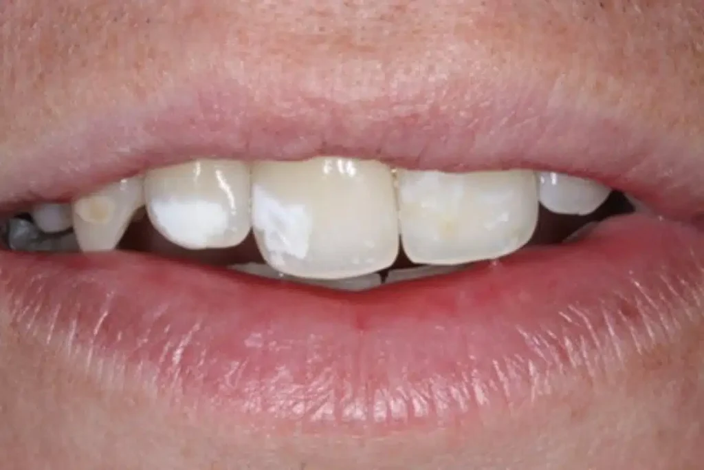 White Spots on Teeth