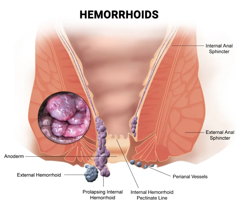 What Does a Hemorrhoid Look Like