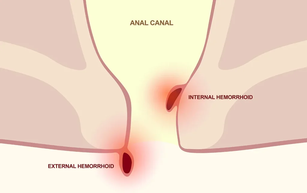 What Does a Hemorrhoid Look Like