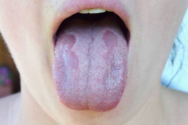 why is my tongue white