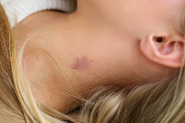 how to give a hickey
