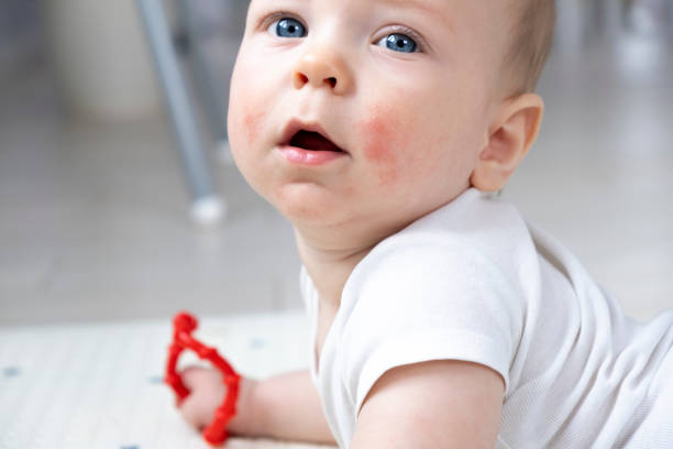 Teething Rash in Babies