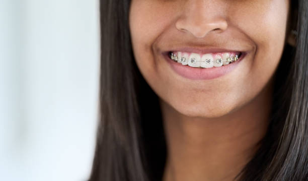 Permanent Retainer