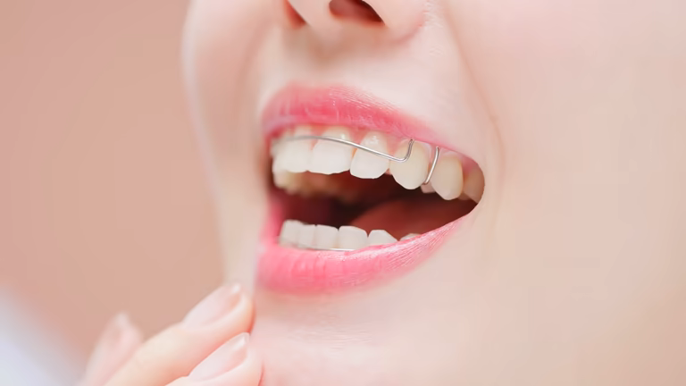 Permanent Retainer