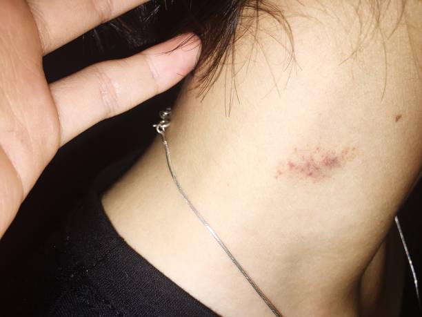 how to give a hickey