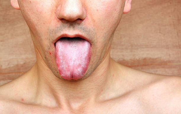 why is my tongue white