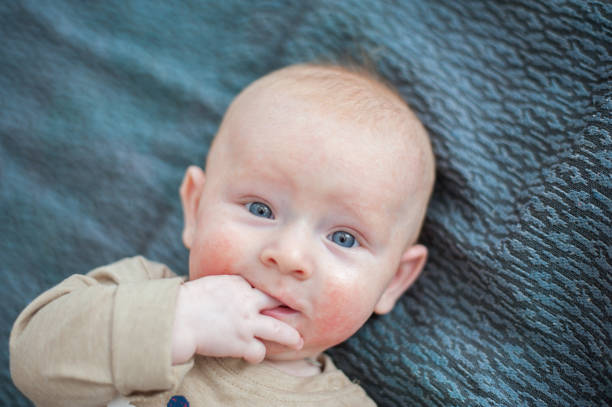 Teething Rash in Babies
