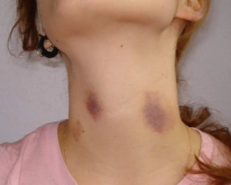 how to give a hickey
